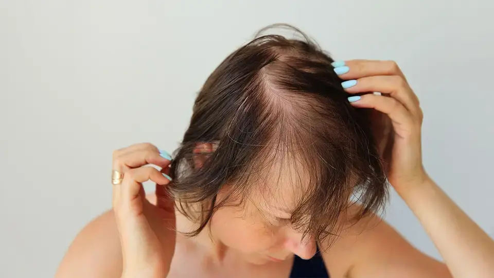 How is hair loss formed?